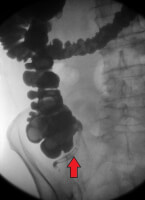 Röntgenonderzoek met contrastvloeistof intraluminaal van de appendix (rode pijl) / Bron: Hellerhoff (bewerkt), Wikimedia Commons (CC BY-SA-3.0)