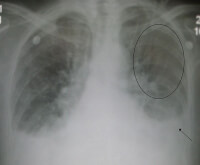 Röntgenfoto met aanwezigheid vocht in de longen (pijl: pleuravocht, cirkel: versterkte longvaattekening) / Bron: James Heilman, MD, Wikimedia Commons (CC BY-SA-3.0)