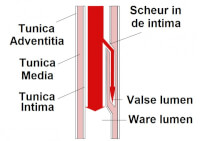 Aorta, bloed stroomt van boven naar onder. De scheur in de wand van de tunica intima is de oorzaak. / Bron: Wikipedia commons