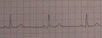 Voorbeeldstrook smalcomplex (QRS-duur <0,12s) bradycardie (frequentie <60 slagen/minuut) / Bron: James Heilman, MD, Wikimedia Commons (CC BY-SA-3.0)
