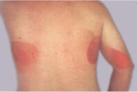 Dermatitis (roodkleurige huid) ontstaan door landurige blootstelling aan Röntgenonderzoek (Fluoroscopie) / Bron: LK Wagner, PhD, Wikimedia Commons (CC BY-SA-3.0)