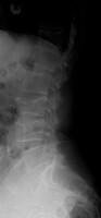 Röntgenfoto rug met ingezakt wervellichaam (derde wervellichaam van onder (L3) heeft hoogteverlies) / Bron: Lucien Monfils, Wikimedia Commons (CC BY-SA-3.0)