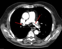 CT-Scan met longembolie (rode pijlen: onderbreking van contrast in longslagader / Bron: James Heilman, MD, Wikimedia Commons (CC BY-SA-3.0)