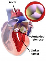 Schematische weergave aortaklepstenose, de aortaklep bevindt zich tussen de linkerkamer en de aorta / Bron: Blausen.com staff, Wikimedia Commons (CC BY-3.0)