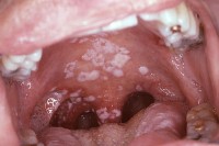 Orale candidiasis infectie / Bron: Sol Silverman, Jr., D.D.S., Wikimedia Commons (Publiek domein)