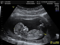 Echografisch onderzoek baby 12 weken oud / Bron: Wolfgang Moroder, Wikimedia Commons (CC BY-SA-3.0)