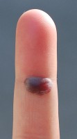 Een bloedblaar op de vinger / Bron: Eremitt, Wikimedia Commons (Publiek domein)