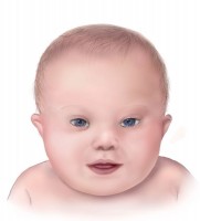 Een tekening van de gezichtskenmerken van een baby met het syndroom van Down / Bron: Centers for Disease Control and Prevention, National Center on Birth Defects and Developmental Disab, Wikimedia Commons (Publiek domein)