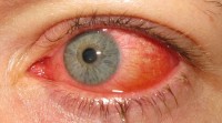 Rode ogen bij conjunctivitis, een oogaandoening die soms zorgt voor dacryostenose / Bron: Marco Mayer, Wikimedia Commons (CC BY-SA-4.0)