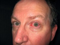 Een oogbindvliesontsteking ontstaat mogelijk ook door stafylokokkenbacteriën / Bron: Son Of Groucho, Flickr (CC BY-2.0)