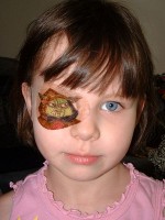 Kinderen met een lui oog moeten soms een ooglapje dragen / Bron: Melissa Gutierrez, Wikimedia Commons (CC BY-SA-2.0)
