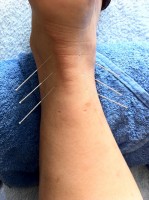 Sommige patiënten met CVS zijn gebaat bij acupunctuur / Bron: Fusiontherapy, Pixabay