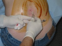 Een lumbale punctie bevestigt pneumokokkenmeningitis / Bron: Brainhell, Wikimedia Commons (CC BY-SA-3.0)