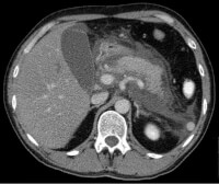 CT-scan waarbij veel vocht rond de alvleesklier aanwezig is, wat wijst op acute pancreatitis / Bron: Hellerhoff, Wikimedia Commons (CC BY-SA-3.0)