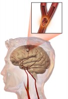 Bij een beroerte (herseninfarct) zal een klein bloedpropje een bloedvat blokkeren, met veel schade in het hersenweefsel als gevolg / Bron: Blausen Medical Communications, Inc., Wikimedia Commons (CC BY-3.0)