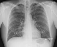 Röntgenfoto van de longen / Bron: Oracast, Pixabay
