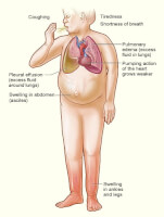 Algemene symptomen van hartfalen (links- en rechtsdecompensatie) / Bron: National Heart, Lung, and Blood Institute, Wou, Wikimedia Commons (Publiek domein)
