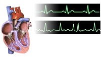Anatomie van het hart, en het ecg / Bron: Blausen.com staff, Wikimedia Commons (CC BY-SA-4.0)