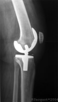 Röntgenfoto knie met prothese / Bron: fpjacquot, Wikimedia Commons (CC BY-SA-3.0)