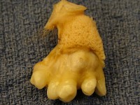 Een dermoïdcyste (7 bij 4 cm) met volgroeide tanden, huid en haar / Bron: Billie Owens, Wikimedia Commons (CC BY-SA-3.0)
