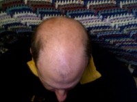 Het typische beeld bij alopecia androgenetica (klassieke mannelijke kaalheid) / Bron: David Lewis, Wikimedia Commons (CC BY-SA-3.0)