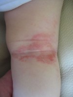 Atopisch eczeem in de knieholte van een baby, als gevolg van een koemelkallergie / Bron: Mech, Wikimedia Commons (Publiek domein)
