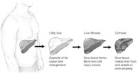 De fases van leverbeschadiging, beginnend bij leververvetting / Bron: Countincr, Wikimedia Commons (Publiek domein)