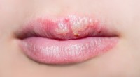 Koortslip veroorzaakt blaasjes op de lip / Bron: Sergii Chepulskyi/Shutterstock.com