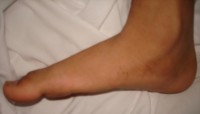 Platvoeten vormen een risicofactor voor shin splints / Bron: Benojeda at English Wikipedia, Wikimedia Commons (Publiek domein)