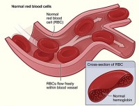 Figuur toont normale rode bloedcellen die vrij in een bloedvat stromen. De inzet toont een dwarsdoorsnede van een normale rode bloedcel met normale hemoglobine. / Bron: NHLBI, Wikimedia Commons (Publiek domein)