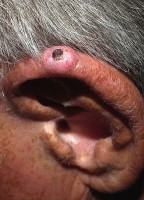 Chondrodermatitis nodularis helicis: korstje op het oor / Bron: Klaus D. Peter, Wikimedia Commons (CC BY-3.0)