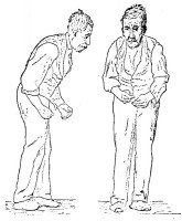 Illustratie van de ziekte van Parkinson door Sir William Richard Gowers uit A Manual of Diseases of the Nervous System in 1886 / Bron: Publiek domein, Wikimedia Commons (PD)