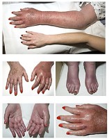Gezwollen voeten en handen bij erythromelalgie / Bron: Herbert L. Fred, MD / Hendrik A. van Dijk, Wikimedia Commons (CC BY-2.0)