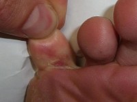 Pijnlijke tenen door voetschimmel / Bron: Ellington, Wikimedia Commons (Publiek domein)