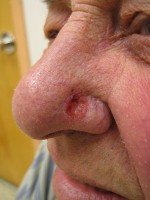 Basaalcelcarcinoom op de neus: een vorm van huidkanker / Bron: James Heilman, MD, Wikimedia Commons (CC BY-3.0)