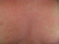 Netelroos en verkleuring van de huid op de rug van iemand met anafylaxie / Bron: James Heilman, MD, Wikimedia Commons (CC BY-SA-3.0)