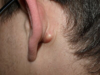 Talgkliercyste achter het oor / Bron: Klaus D. Peter, Wikimedia Commons (CC BY-3.0)