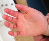 Blaasjes op de hand van een kind met hand-, voet- en mondziekte / Bron: Gzzz, Wikimedia Commons (CC BY-SA-4.0)
