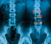 Röntgenfoto: vergelijking onderrug tussen gezond persoon en iemand met Bechterew / Bron: Suttha Burawonk/Shutterstock