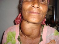 Een enorm vergrote schildklier bij een Indiase vrouw / Bron: Dr. J.S.Bhandari, Wikimedia Commons (CC BY-SA-3.0)