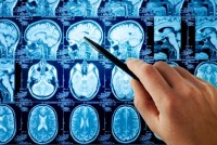 MRI-scan van de hersenen / Bron: Triff/Shutterstock.com