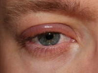 Jeukende oogleden door blefaritis / Bron: Clubtable, Wikimedia Commons (Publiek domein)