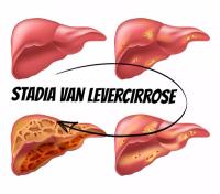 Stadia van levercirrose / Bron: Elen Bushe/Shutterstock.com