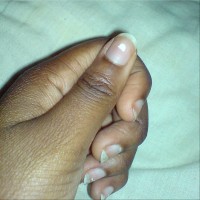 Witte vlekjes op de nagel (leukonychia) / Bron: Londonsista, Wikimedia Commons (Publiek domein)
