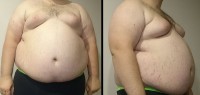 Een man met duidelijke centrale obesitas, een kenmerk van het metabool syndroom. Zijn gewicht is 182 kg, zijn lengte 185 cm en body mass index (BMI) 53 (normaal 18,5 tot 25). / Bron: FatM1ke, Wikimedia Commons (Publiek domein)