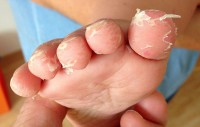 Vervelling van de voet van een kind met hand-, voet- en mondziekte / Bron: Gzzz, Wikimedia Commons (CC BY-SA-4.0)
