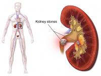 Niersteen kan pijn aan de nier veroorzaken / Bron: Blausen.com, Wikimedia Commons (CC BY-3.0)