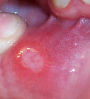 Afteuze zweertjes in de mond bij de ziekte van Crohn / Bron: Photographer: TheBlunderbuss, Wikimedia Commons (CC BY-SA-3.0)