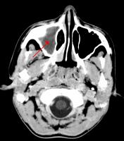 Kaakholteontsteking. De sinus maxillaris (rode pijl) is licht gekleurd door ontstoken slijmvlies en vocht in de holte. Normaal zijn de holten op de foto donkerder dan het omgevende bot omdat er lucht in zit. / Bron: James Heilman, MD, Wikimedia Commons (CC BY-SA-3.0)