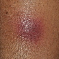 Erythema nodosum: pijnlijke rode en warme bulten op de benen / Bron: Biswarup Ganguly, Wikimedia Commons (CC BY-3.0)